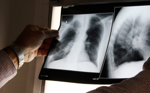Une cinquantaine de Polynésiens touchés chaque année par la tuberculose