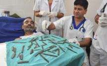 Inde : un homme opéré après avoir avalé 40 couteaux