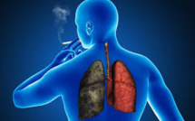 Sida: les fumeurs ont un risque nettement plus élevé de décéder d'un cancer pulmonaire