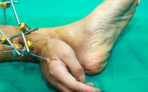 La main d'un Chinois greffée provisoirement sur sa jambe avant de retrouver son poignet