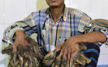 Bangladesh: un "homme-arbre" aux excroissances impressionnantes opéré